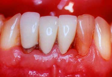 periodontitis