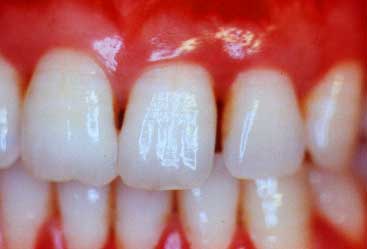 Drug may guard against periodontitis, and related chronic diseases