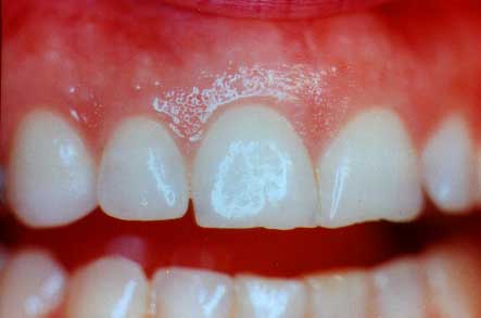 Gum Recession : Bacterial Infection (Periodontitis)