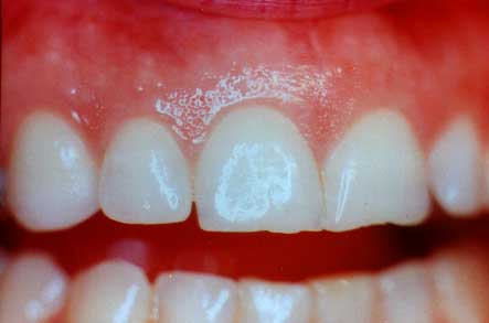 Healthy+gums+images