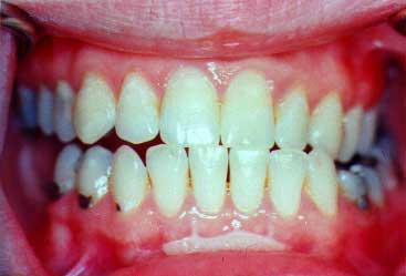 What can cause dark gums around someone's teeth?